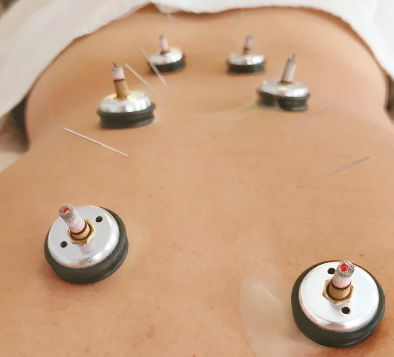 Tratamiento del Dolor con Acupuntura