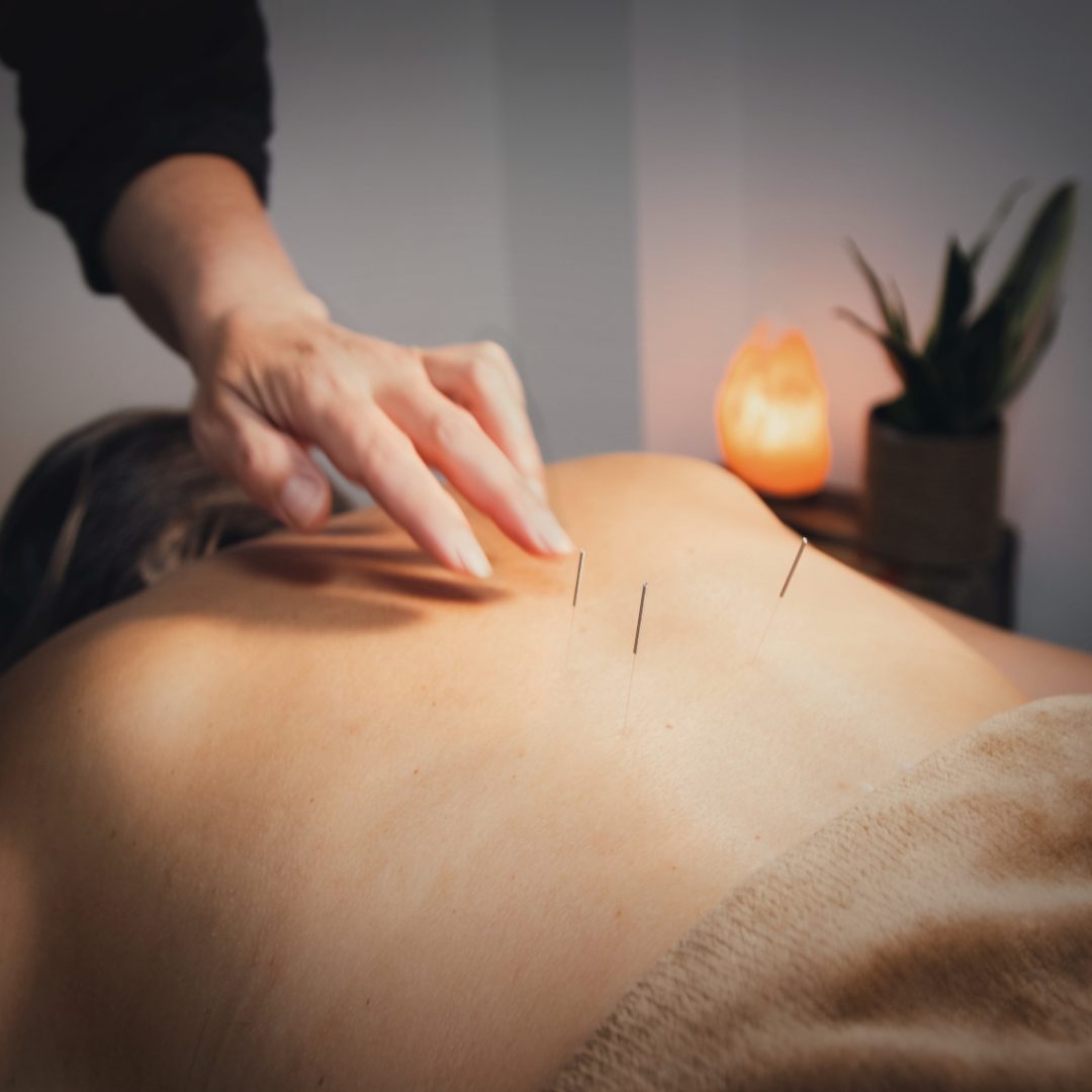 Acupuntura2